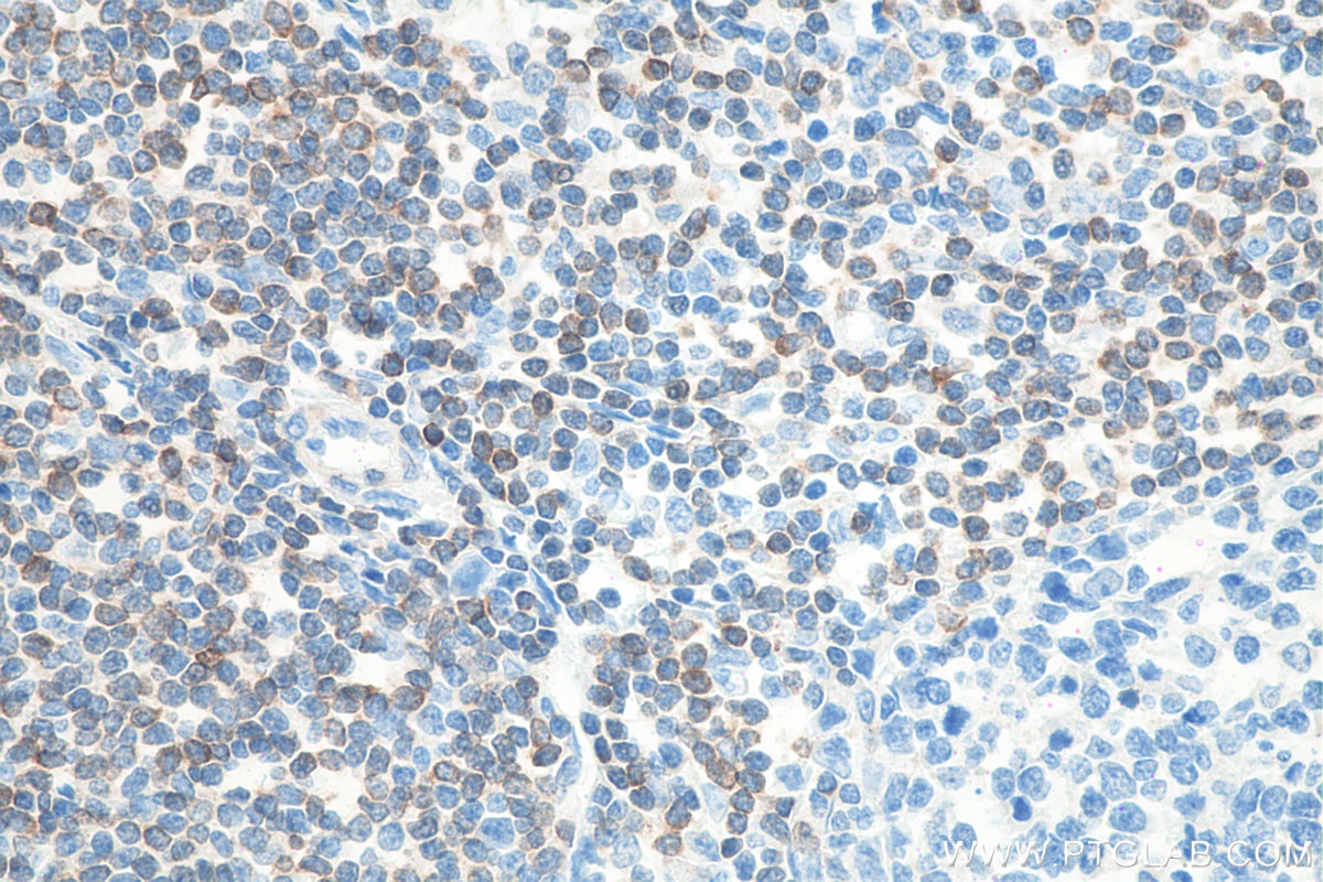 Immunohistochemistry (IHC) staining of human tonsillitis tissue using BCL2 Recombinant antibody (80313-1-RR)