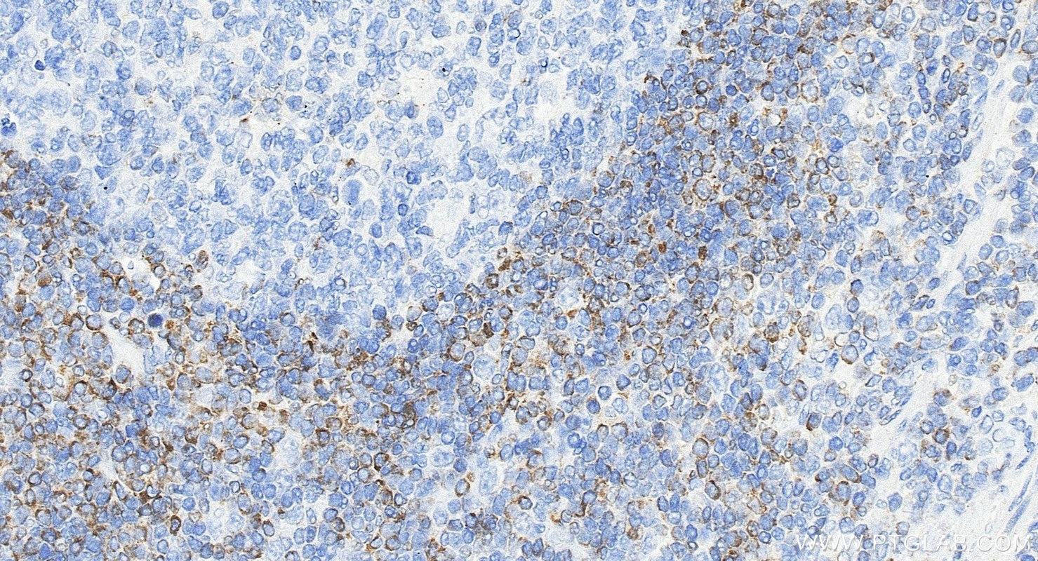 IHC staining of human appendicitis using 80313-1-RR Immunohistochemistry (IHC) staining of human appendicitis tissue using BCL2 Recombinant monoclonal antibody (80313-1-RR)