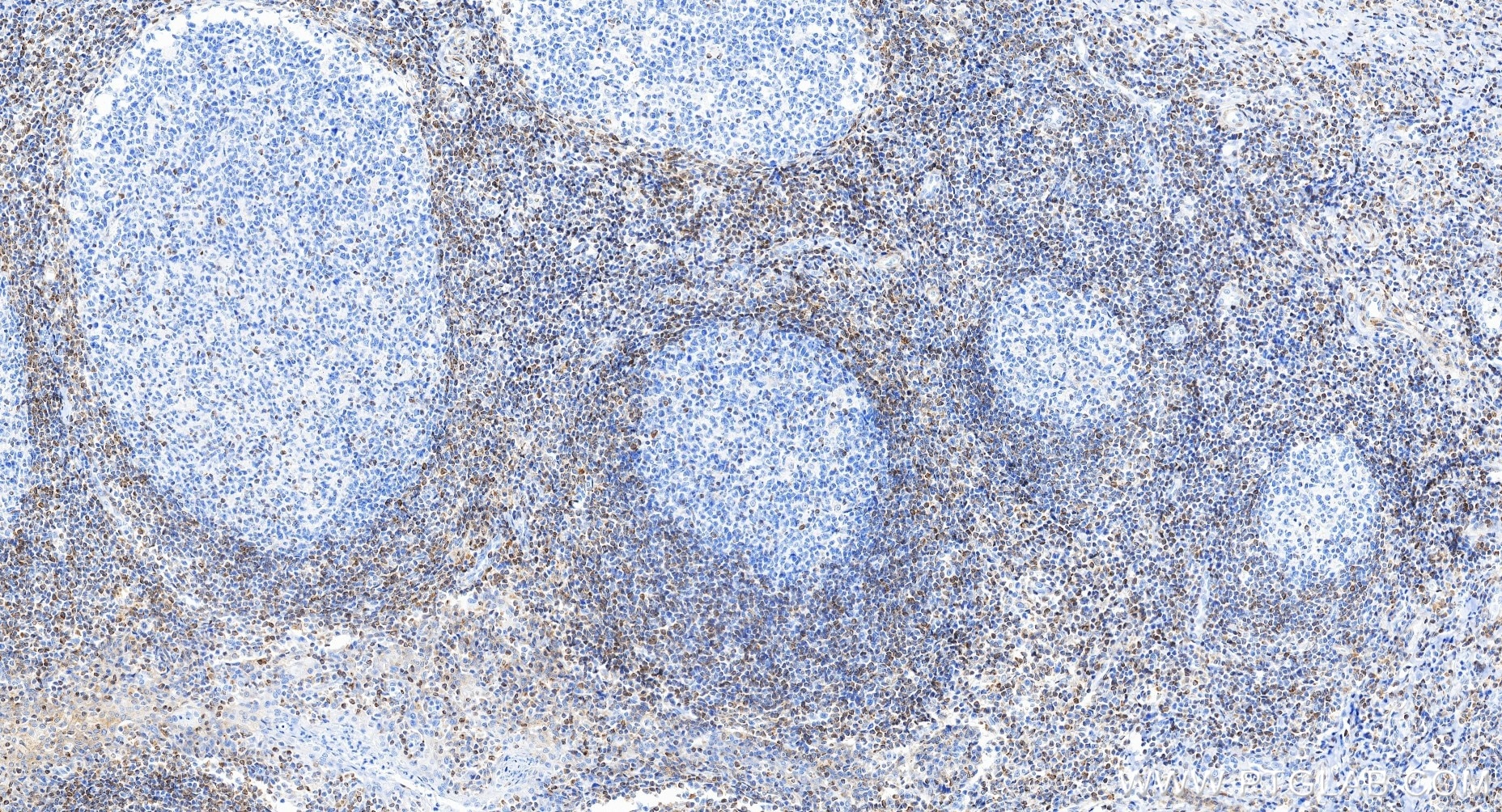 Immunohistochemistry (IHC) staining of human tonsillitis tissue using BCL2 Recombinant monoclonal antibody (80313-1-RR)