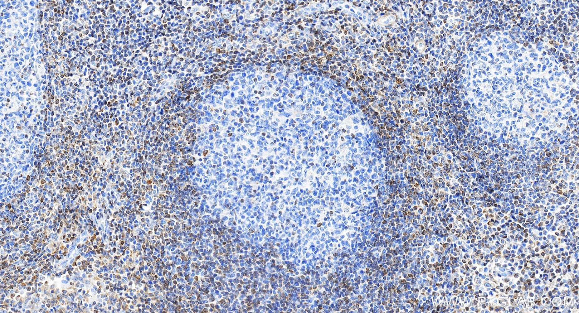 Immunohistochemistry (IHC) staining of human tonsillitis tissue using BCL2 Recombinant monoclonal antibody (80313-1-RR)