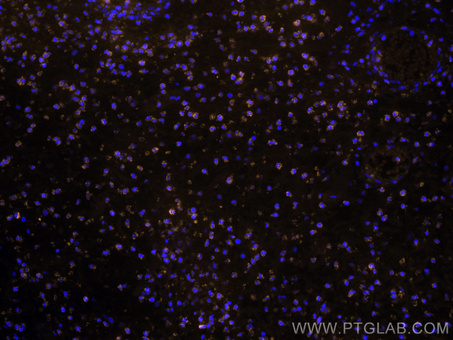 Immunofluorescence (IF) / fluorescent staining of human appendicitis tissue using CoraLite®555-conjugated BCL2 Monoclonal antibody (CL555-60178)