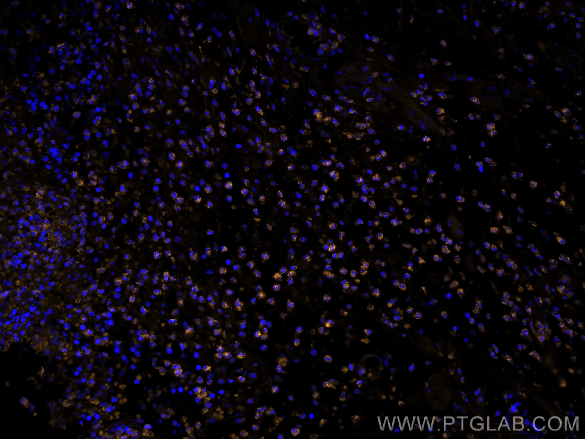Immunofluorescence (IF) / fluorescent staining of human appendicitis tissue using CoraLite®555-conjugated BCL2 Recombinant antibody (CL555-80313)