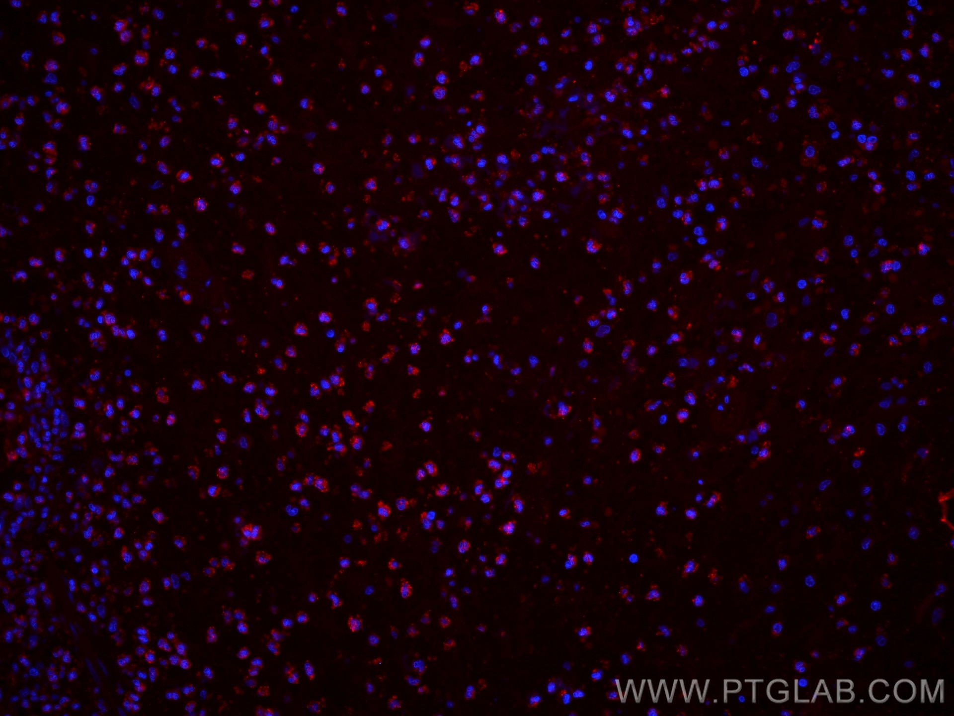 Immunofluorescence (IF) / fluorescent staining of human appendicitis tissue using CoraLite®594-conjugated BCL2 Recombinant antibody (CL594-80313)