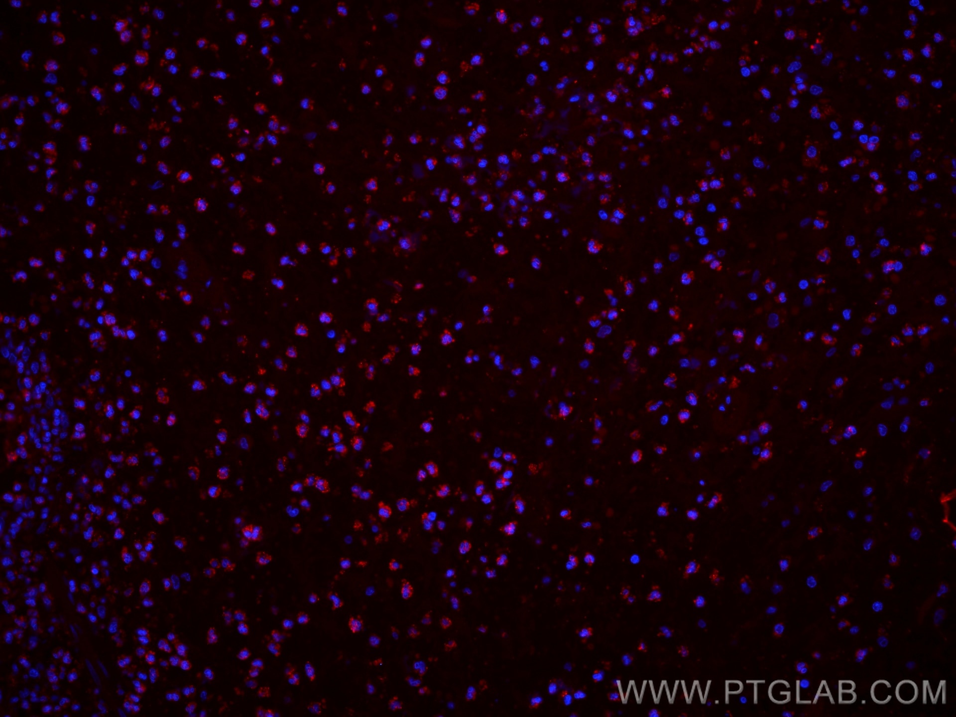 IF Staining of human appendicitis using CL594-80313