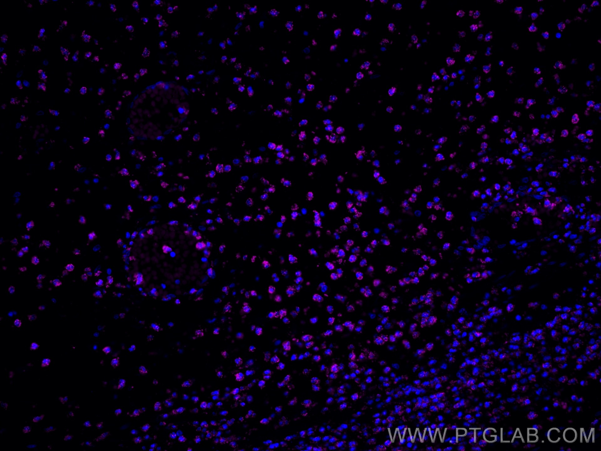 Immunofluorescence (IF) / fluorescent staining of human appendicitis tissue using CoraLite® Plus 647-conjugated BCL2 Recombinant ant (CL647-80313)