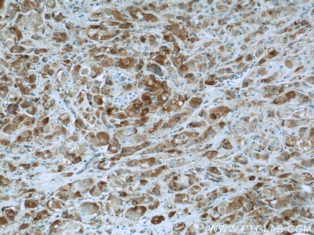 Immunohistochemistry (IHC) staining of human breast cancer tissue using BCL2L12 Polyclonal antibody (21969-1-AP)