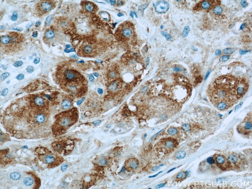 Immunohistochemistry (IHC) staining of human breast cancer tissue using BCL2L12 Polyclonal antibody (21969-1-AP)