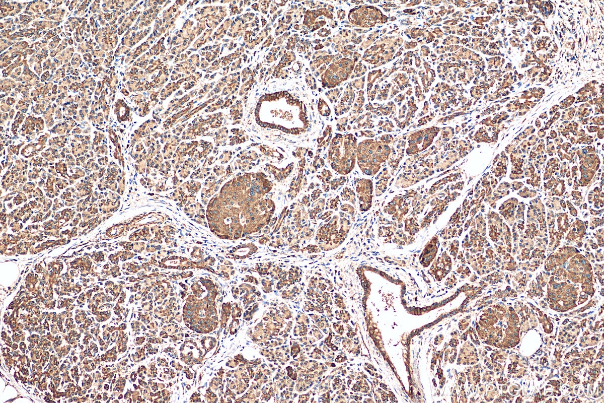 Immunohistochemistry (IHC) staining of human pancreas cancer tissue using BCL2L13 Polyclonal antibody (16612-1-AP)