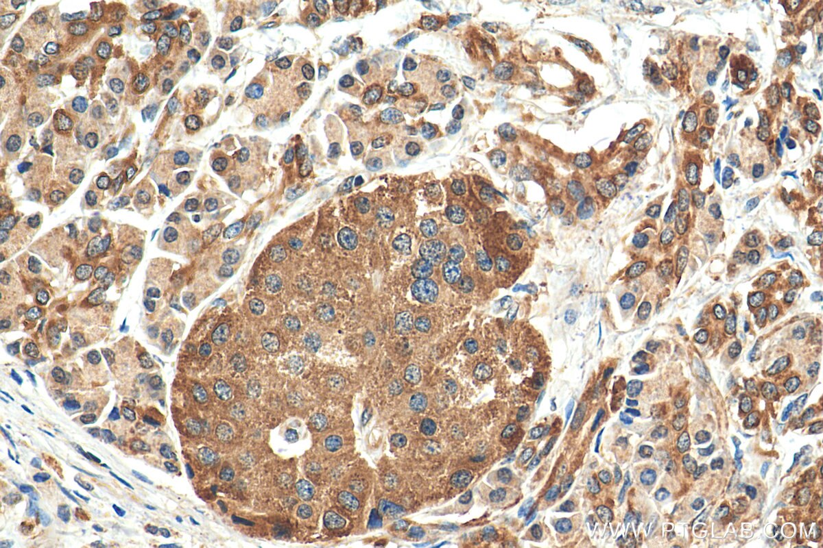 Immunohistochemistry (IHC) staining of human pancreas cancer tissue using BCL2L13 Polyclonal antibody (16612-1-AP)