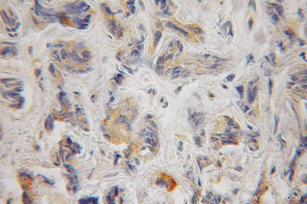 Immunohistochemistry (IHC) staining of human prostate cancer tissue using BCL2L14 Polyclonal antibody (12846-1-AP)