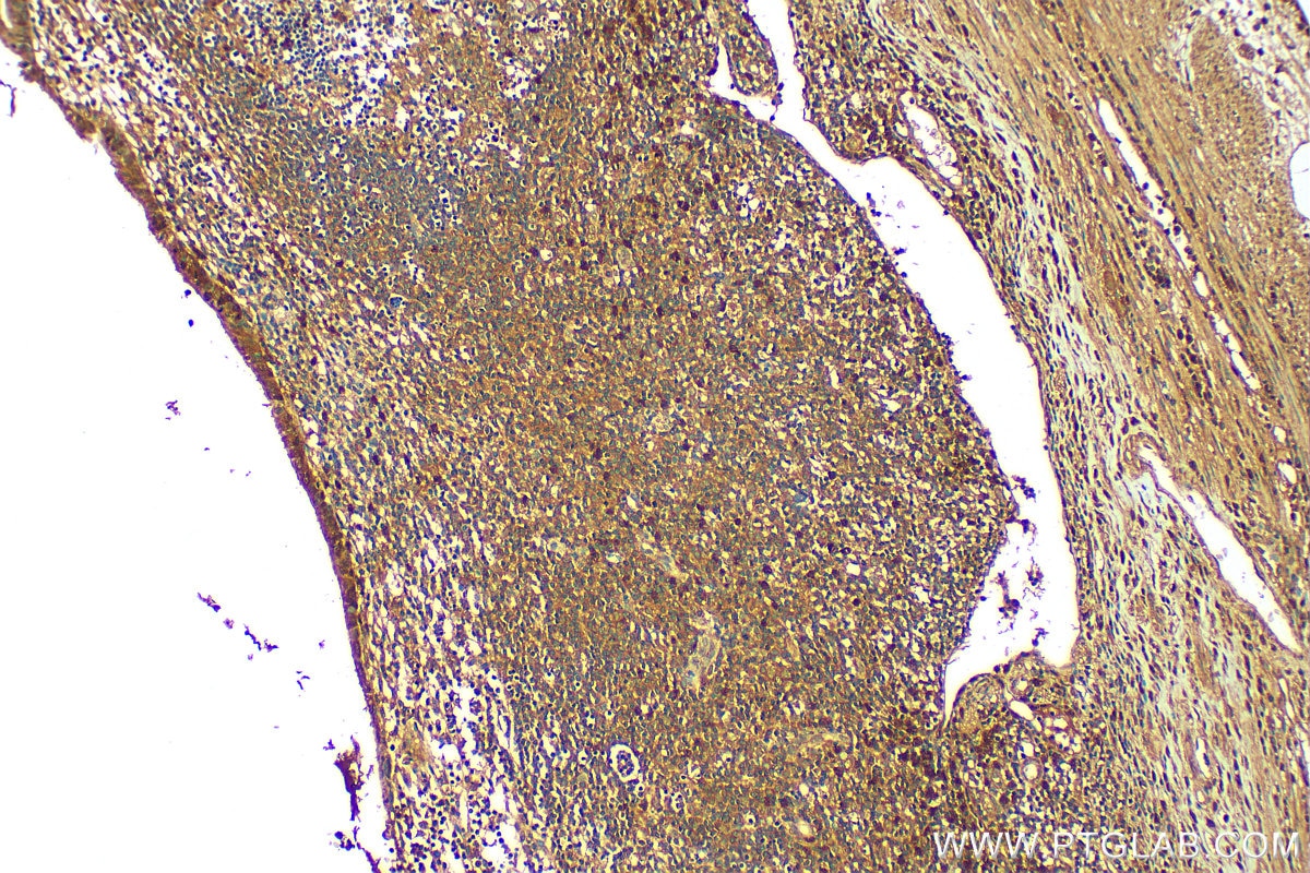 Immunohistochemistry (IHC) staining of human appendicitis tissue using BCL2L15 Polyclonal antibody (23975-1-AP)