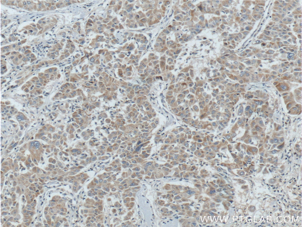 Immunohistochemistry (IHC) staining of human liver cancer tissue using BCL2L2 Polyclonal antibody (16026-1-AP)