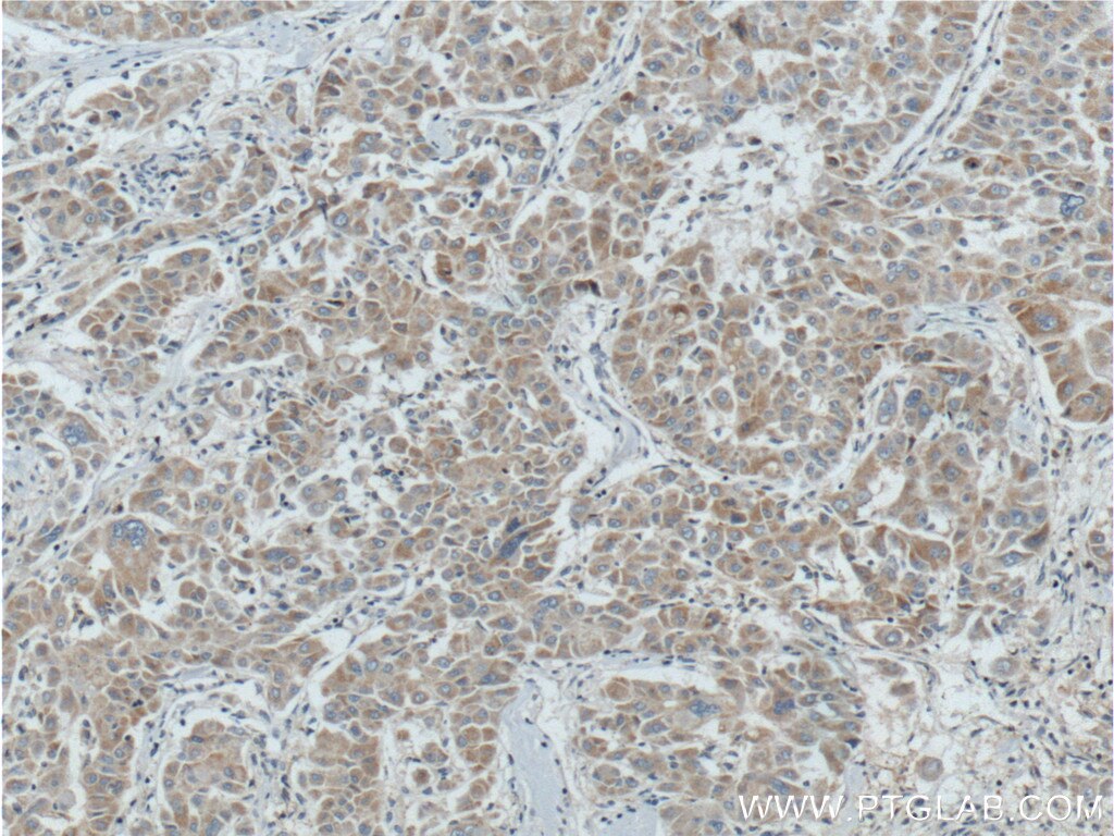 Immunohistochemistry (IHC) staining of human liver cancer tissue using BCL2L2 Polyclonal antibody (16026-1-AP)