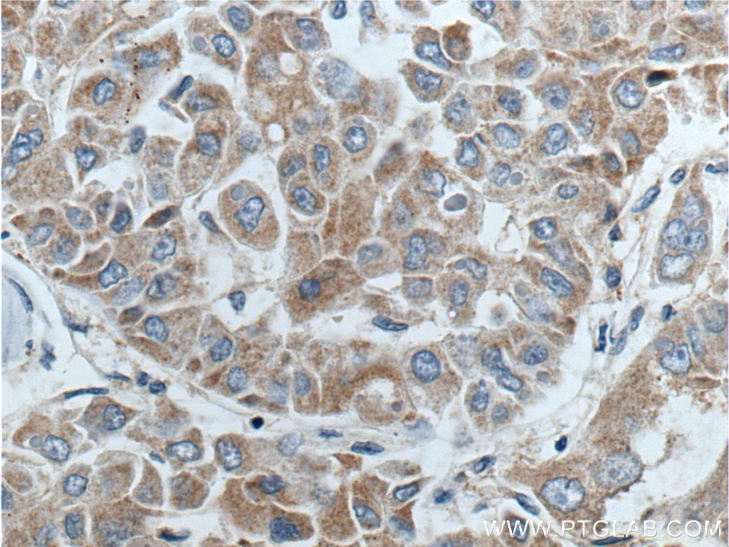 Immunohistochemistry (IHC) staining of human liver cancer tissue using BCL2L2 Polyclonal antibody (16026-1-AP)