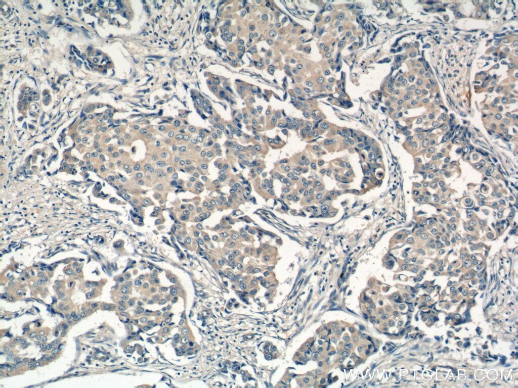 Immunohistochemistry (IHC) staining of human breast cancer tissue using BCL2L2 Polyclonal antibody (25850-1-AP)