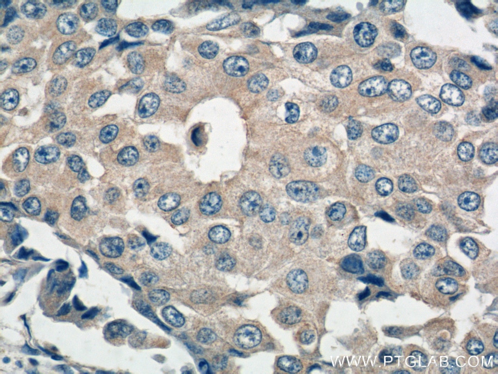 Immunohistochemistry (IHC) staining of human breast cancer tissue using BCL2L2 Polyclonal antibody (25850-1-AP)