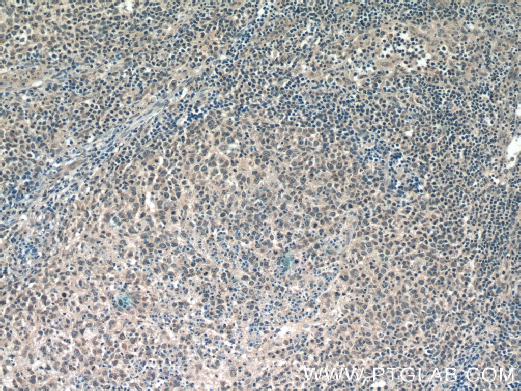 Immunohistochemistry (IHC) staining of human lymphoma tissue using BCL3 Polyclonal antibody (23959-1-AP)