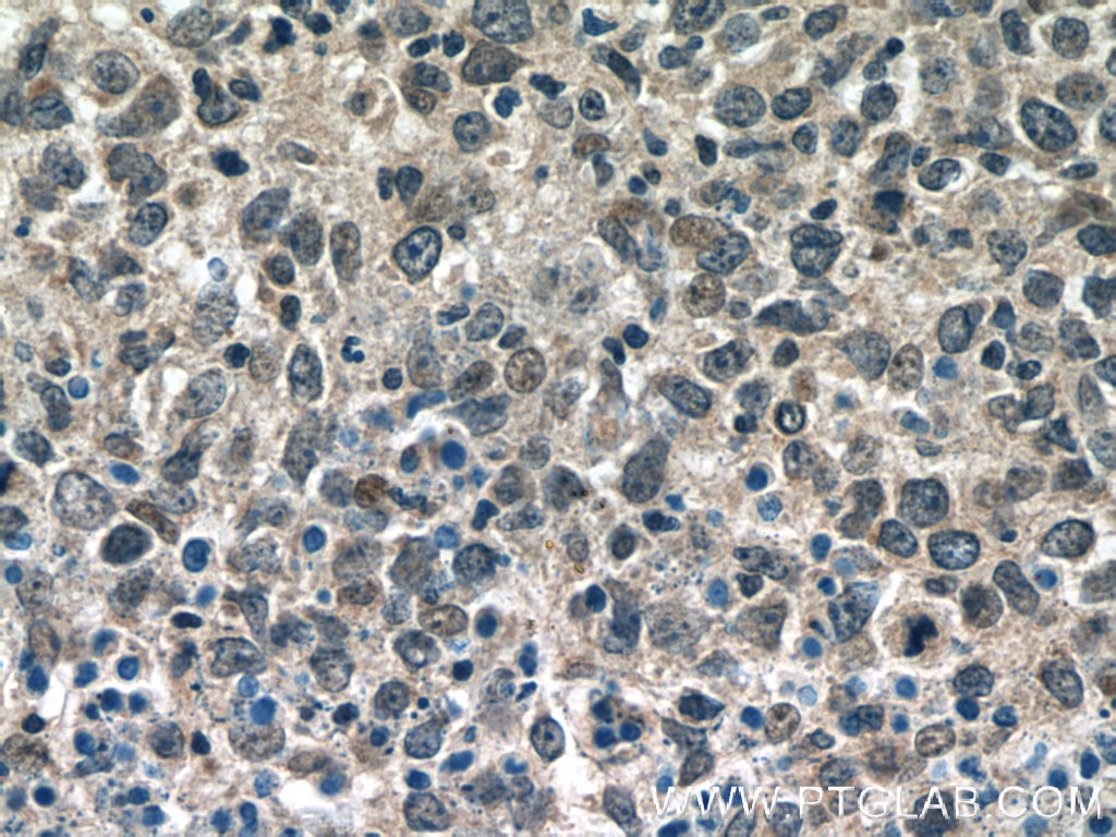 Immunohistochemistry (IHC) staining of human lymphoma tissue using BCL3 Polyclonal antibody (23959-1-AP)