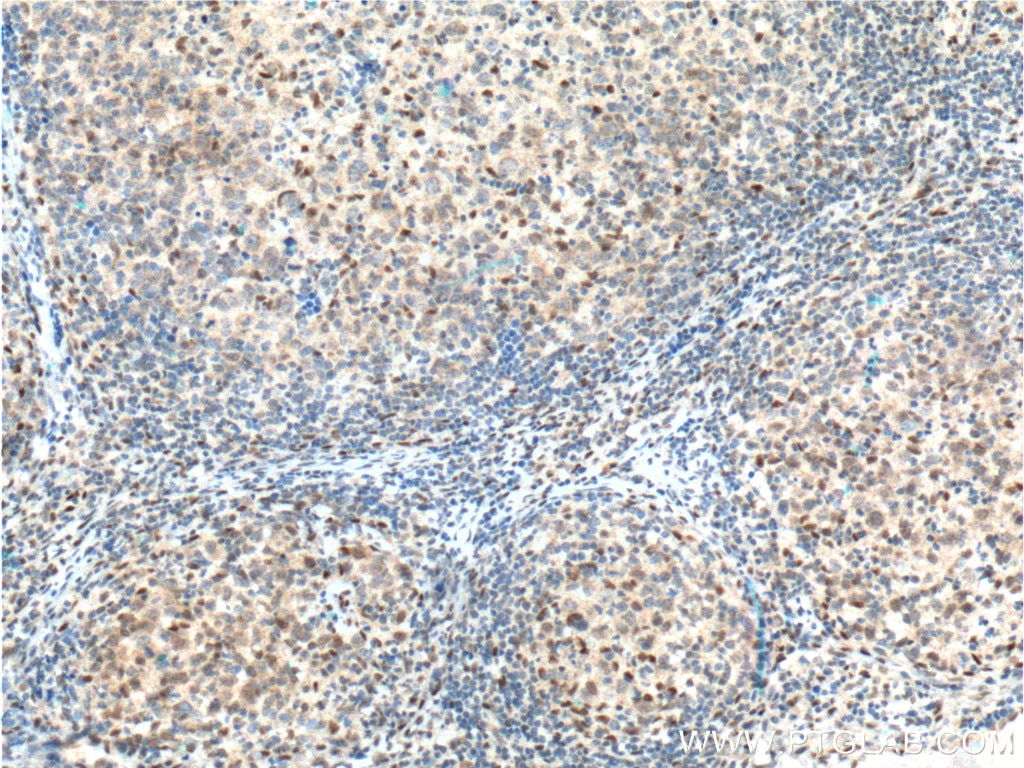 Immunohistochemistry (IHC) staining of human lymphoma tissue using BCL3 Polyclonal antibody (23959-1-AP)