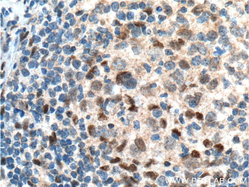 Immunohistochemistry (IHC) staining of human lymphoma tissue using BCL3 Polyclonal antibody (23959-1-AP)