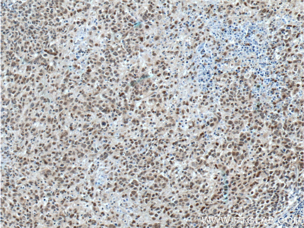 Immunohistochemistry (IHC) staining of human lymphoma tissue using BCL3 Polyclonal antibody (23959-1-AP)