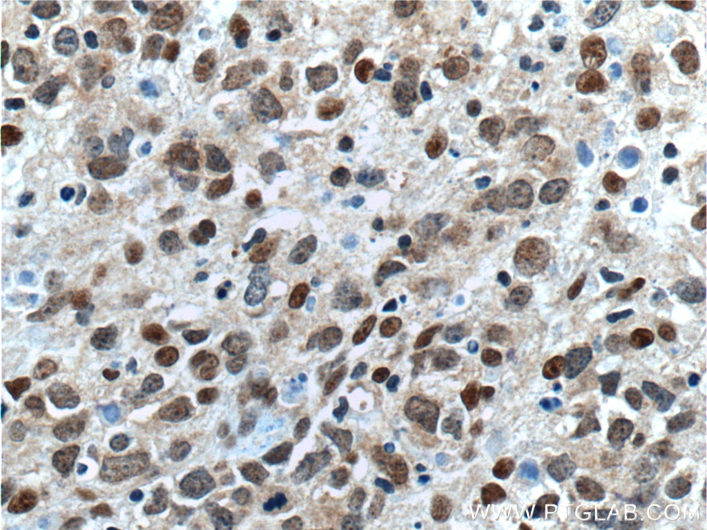 Immunohistochemistry (IHC) staining of human lymphoma tissue using BCL3 Polyclonal antibody (23959-1-AP)