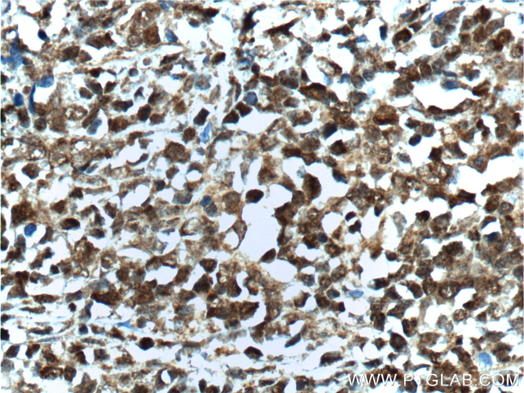 Immunohistochemistry (IHC) staining of human lymphoma tissue using BCL6 Polyclonal antibody (21187-1-AP)