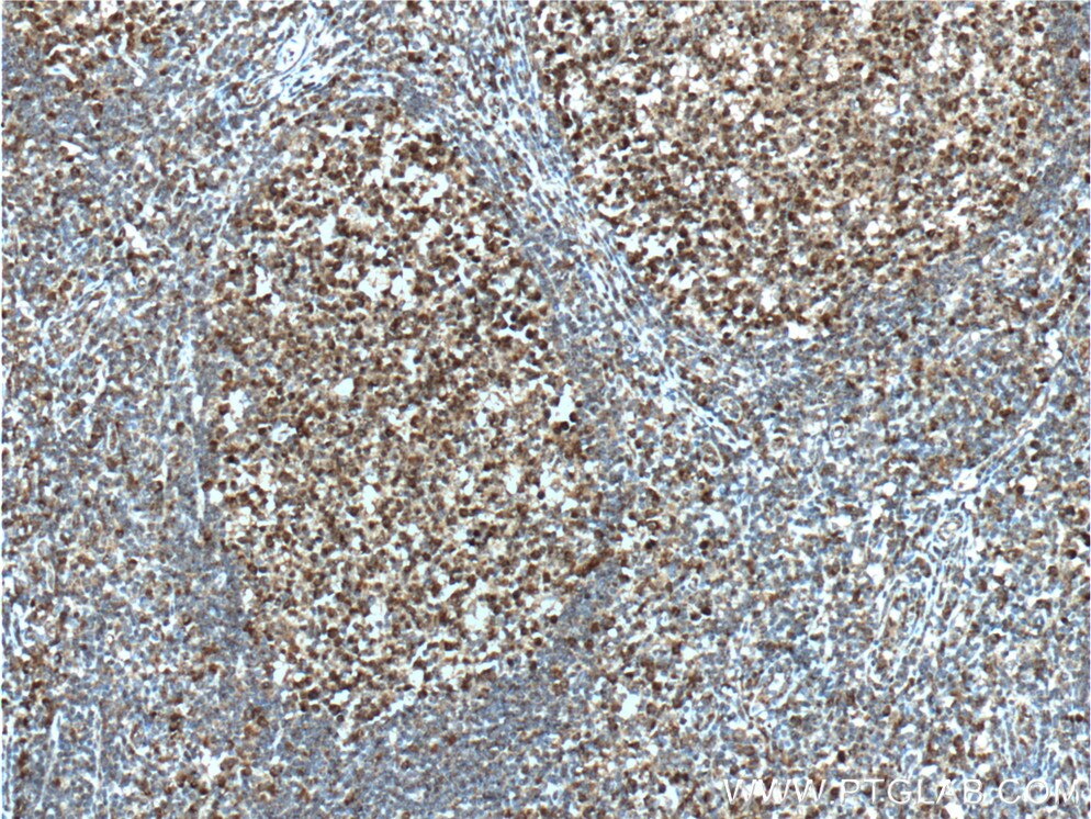 Immunohistochemistry (IHC) staining of human tonsillitis tissue using BCL6 Polyclonal antibody (21187-1-AP)