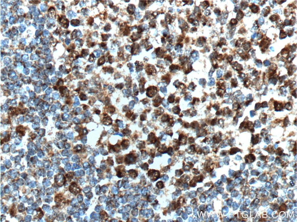 Immunohistochemistry (IHC) staining of human tonsillitis tissue using BCL6 Polyclonal antibody (21187-1-AP)