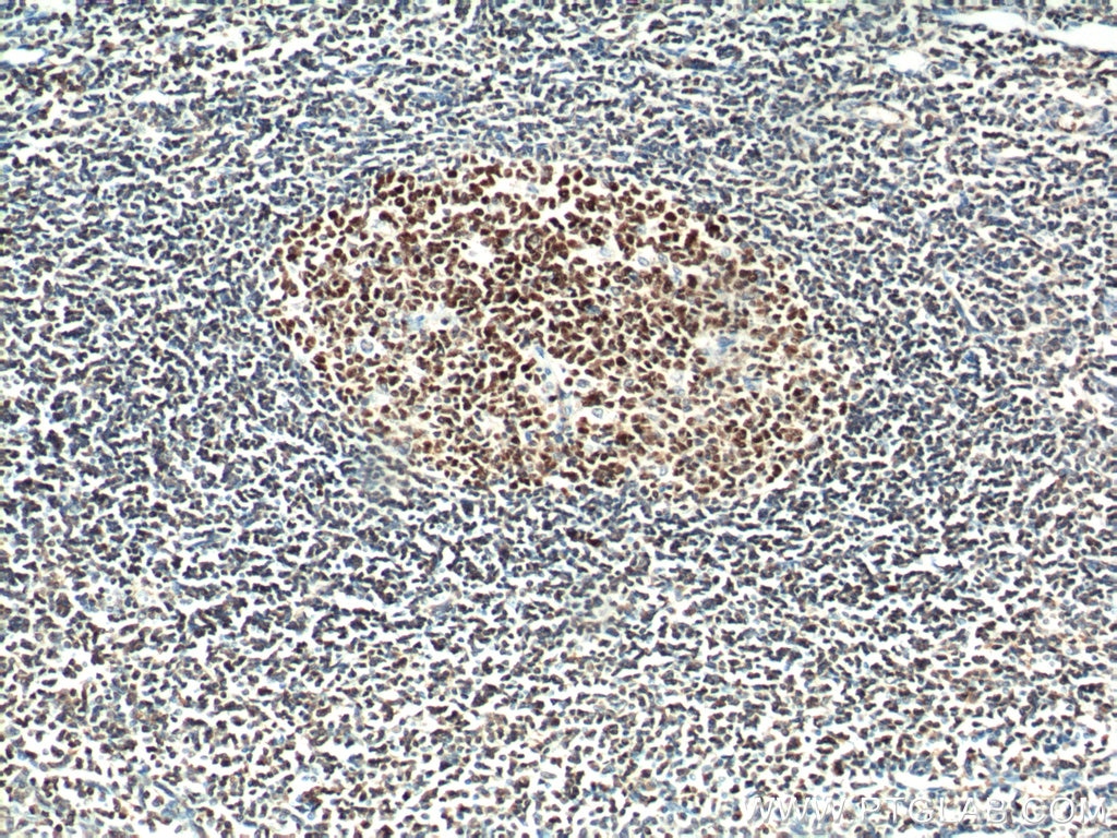 Immunohistochemistry (IHC) staining of human tonsillitis tissue using BCL6 Monoclonal antibody (66340-1-Ig)