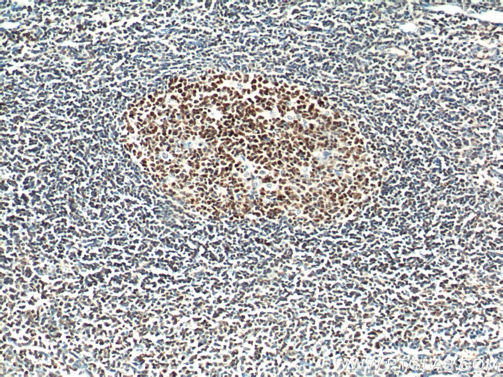 IHC staining of human tonsillitis using 66340-1-Ig