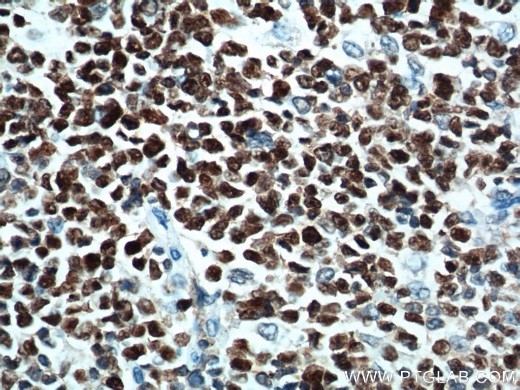 Immunohistochemistry (IHC) staining of human tonsillitis tissue using BCL6 Monoclonal antibody (66340-1-Ig)