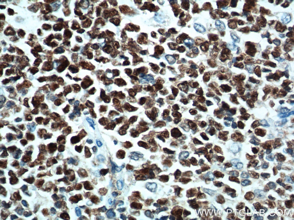 IHC staining of human tonsillitis using 66340-1-Ig