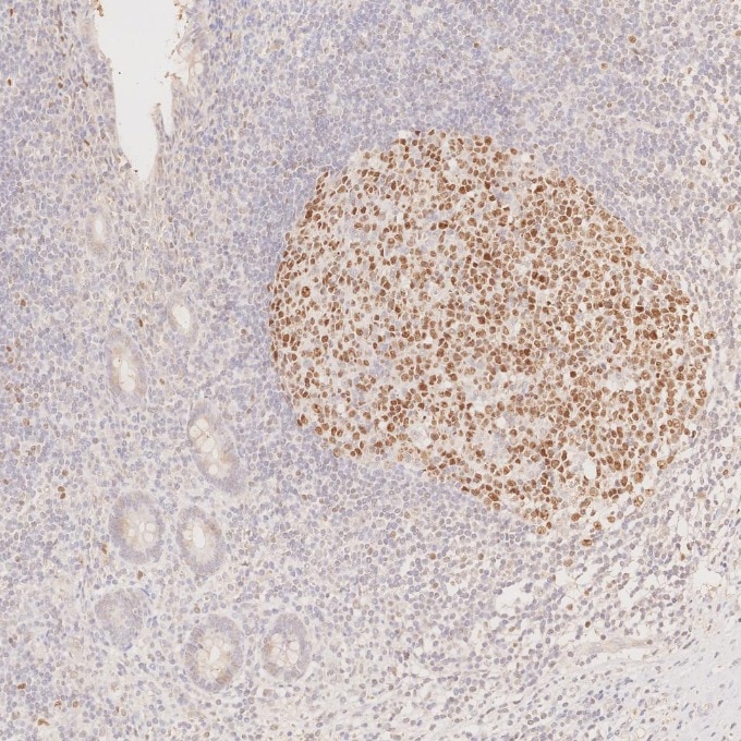 IHC staining of human appendicitis using 66340-1-Ig Immunohistochemistry (IHC) staining of human appendicitis tissue using BCL6 Monoclonal antibody (66340-1-Ig)
