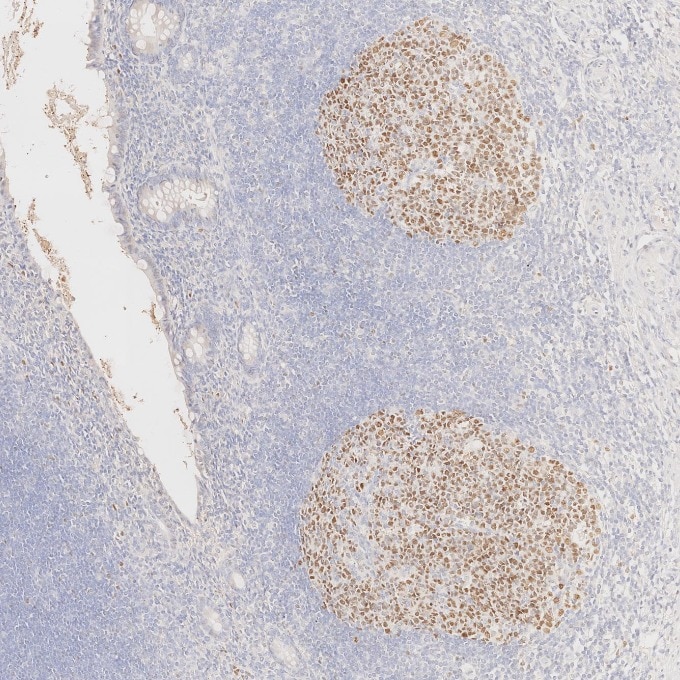 IHC staining of human appendicitis using 66340-1-Ig Immunohistochemistry (IHC) staining of human appendicitis tissue using BCL6 Monoclonal antibody (66340-1-Ig)