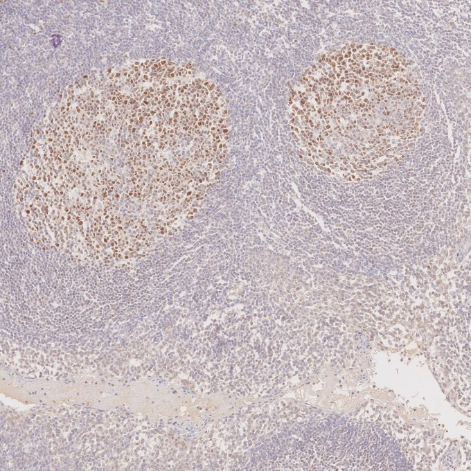 IHC staining of human tonsillitis using 66340-1-Ig Immunohistochemistry (IHC) staining of human tonsillitis tissue using BCL6 Monoclonal antibody (66340-1-Ig)