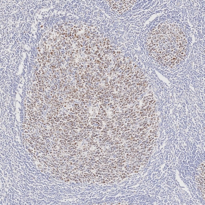 IHC staining of human tonsillitis using 66340-1-Ig Immunohistochemistry (IHC) staining of human tonsillitis tissue using BCL6 Monoclonal antibody (66340-1-Ig)