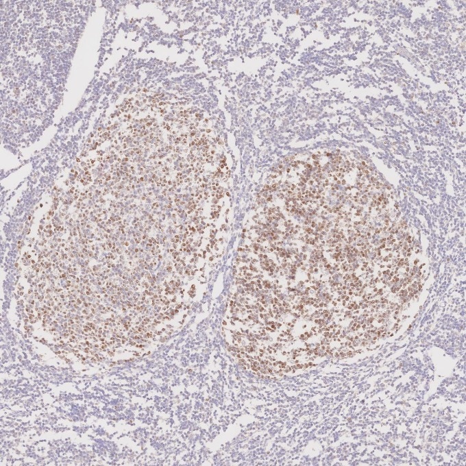 IHC staining of human tonsillitis using 66340-1-Ig Immunohistochemistry (IHC) staining of human tonsillitis tissue using BCL6 Monoclonal antibody (66340-1-Ig)