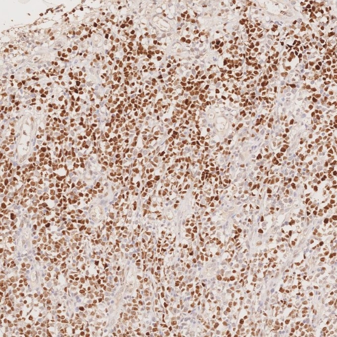 IHC staining of human lymphoma using 66340-1-Ig Immunohistochemistry (IHC) staining of human lymphoma tissue using BCL6 Monoclonal antibody (66340-1-Ig)