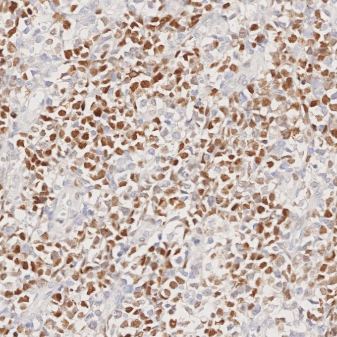 IHC staining of human lymphoma using 66340-1-Ig Immunohistochemistry (IHC) staining of human lymphoma tissue using BCL6 Monoclonal antibody (66340-1-Ig)