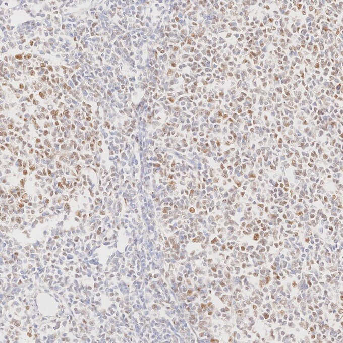 IHC staining of human lymphoma using 66340-1-Ig Immunohistochemistry (IHC) staining of human lymphoma tissue using BCL6 Monoclonal antibody (66340-1-Ig)