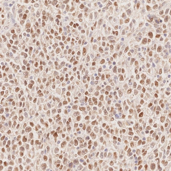 IHC staining of human lymphoma using 66340-1-Ig Immunohistochemistry (IHC) staining of human lymphoma tissue using BCL6 Monoclonal antibody (66340-1-Ig)