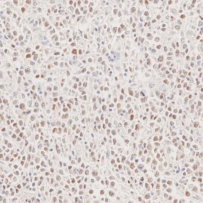 IHC staining of human lymphoma using 66340-1-Ig Immunohistochemistry (IHC) staining of human lymphoma tissue using BCL6 Monoclonal antibody (66340-1-Ig)