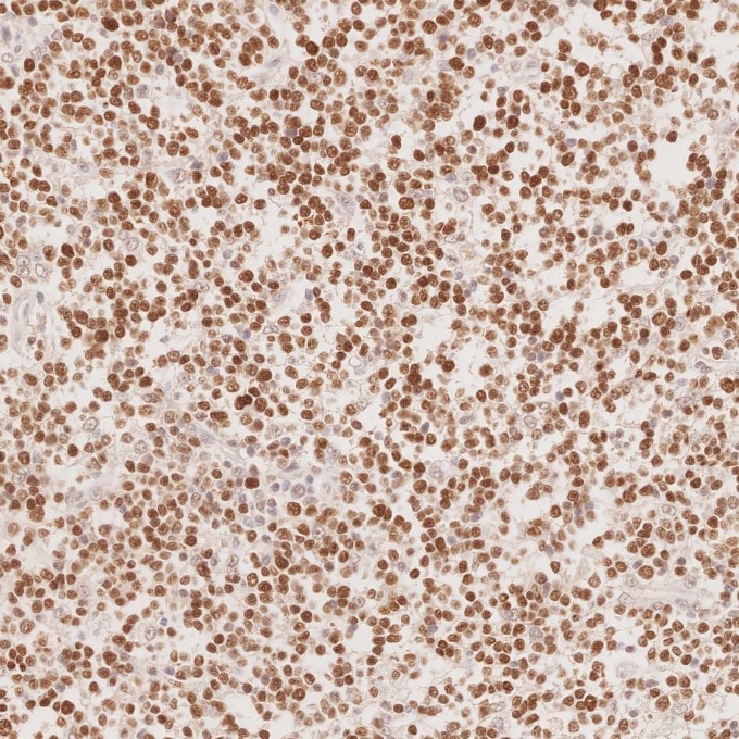 IHC staining of human lymphoma using 66340-1-Ig Immunohistochemistry (IHC) staining of human lymphoma tissue using BCL6 Monoclonal antibody (66340-1-Ig)