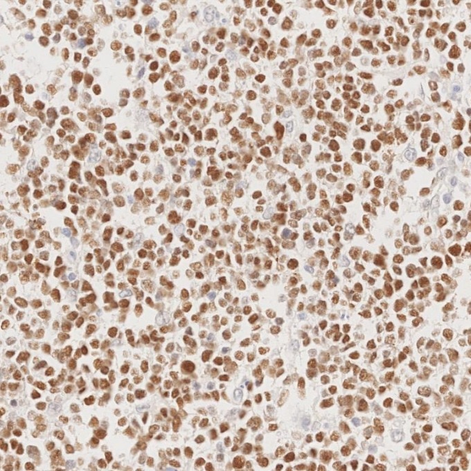 IHC staining of human lymphoma using 66340-1-Ig Immunohistochemistry (IHC) staining of human lymphoma tissue using BCL6 Monoclonal antibody (66340-1-Ig)