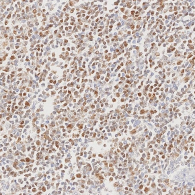 IHC staining of human lymphoma using 66340-1-Ig Immunohistochemistry (IHC) staining of human lymphoma tissue using BCL6 Monoclonal antibody (66340-1-Ig)