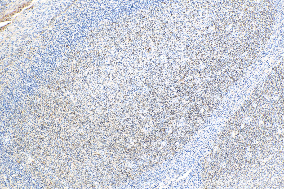 IHC staining of human tonsillitis using 81754-1-RR