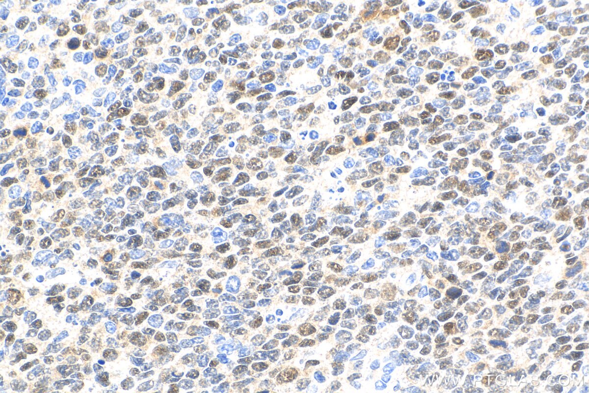 IHC staining of human tonsillitis using 81754-1-RR