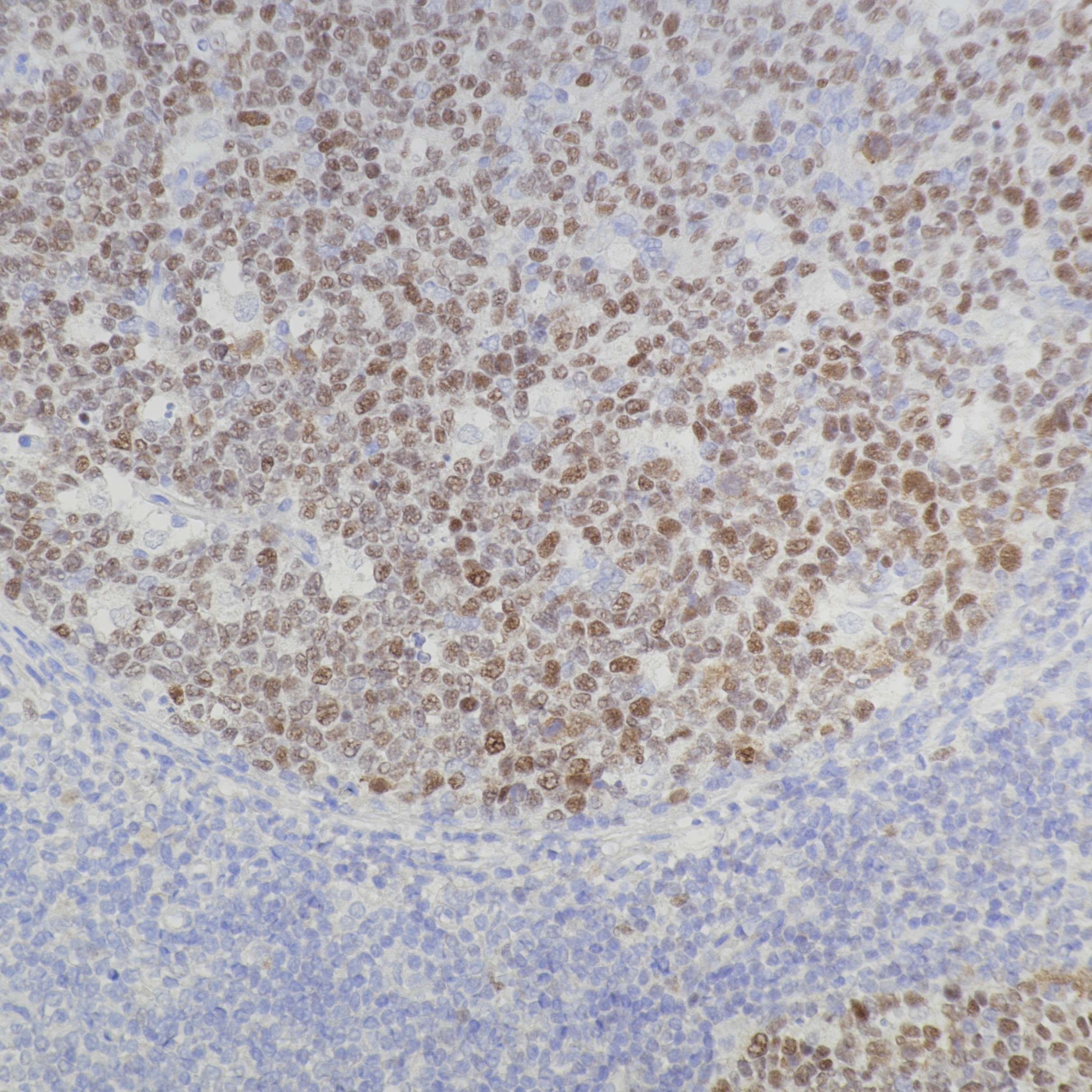 IHC staining of human tonsil using 81754-1-RR Immunohistochemistry (IHC) staining of human tonsil tissue using BCL6 Recombinant monoclonal antibody (81754-1-RR)