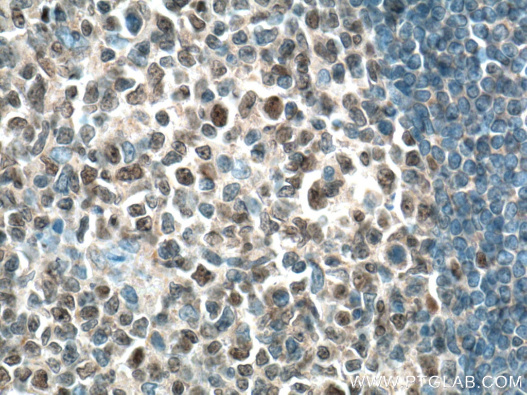 IHC staining of human tonsillitis using Biotin-66340